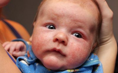 Qu’est ce que l’eczéma atopique?