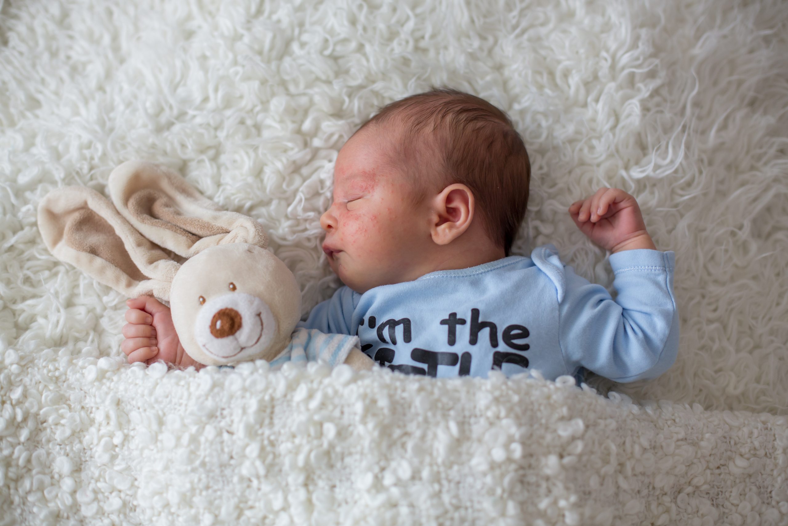 Little newborn baby sleeping, baby with scin rash