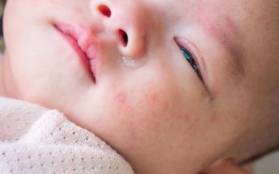 Comment appliquer les soins émollients sur la peau atopique de votre bébé ?