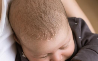 Tout savoir sur les croûtes de lait